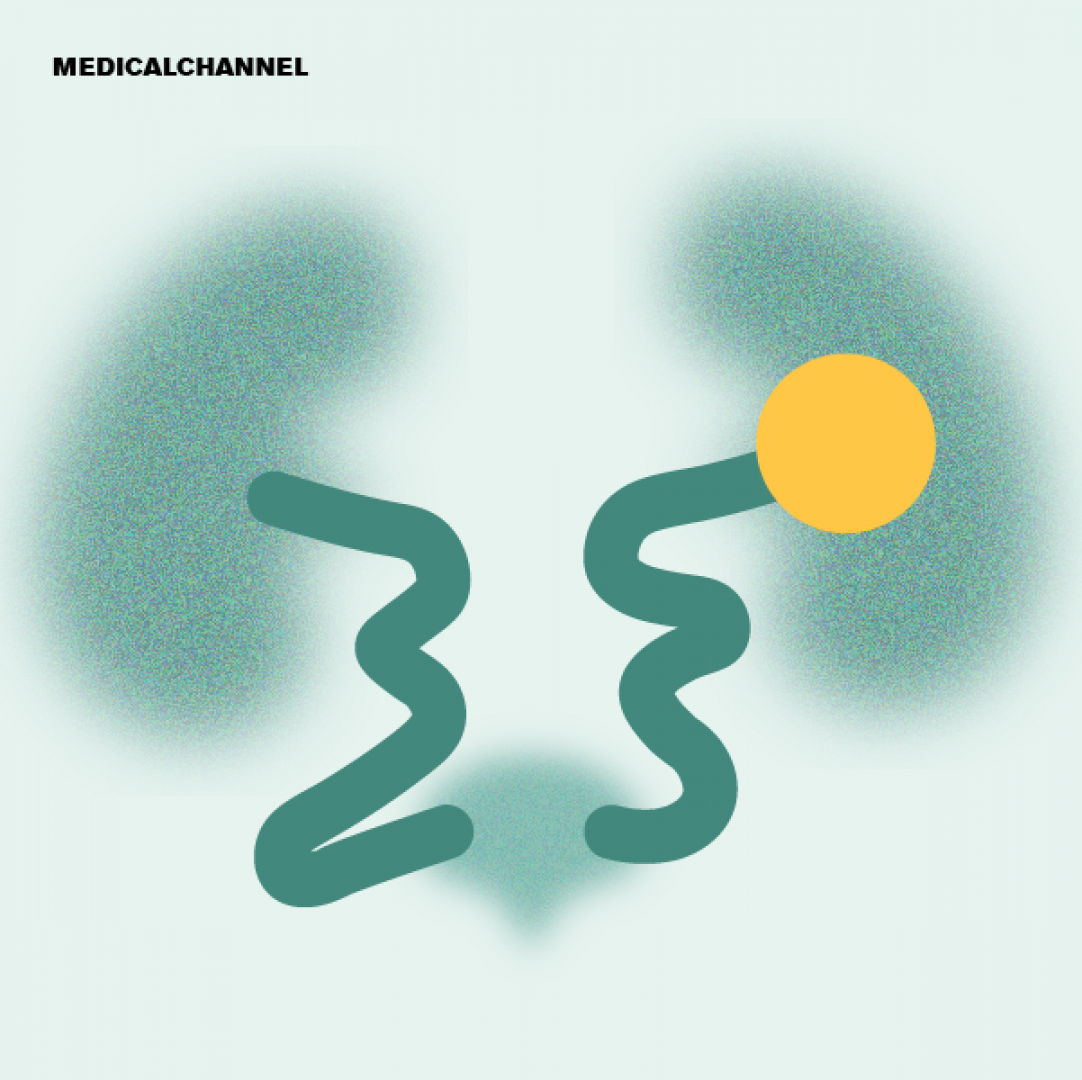 Advances in Kidney Disease Management and Therapeutics